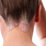 Psoriasis On The Hairline And On The Scalp