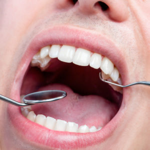 Human male mouth showing teeth with dental hatchet and mouth mirror.