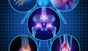 Cannabis and Musculoskeletal Issues: Why It’s a Viable Alternative to Traditional Meds