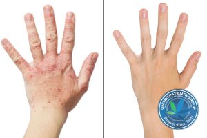 Real Photo Girl's Hand, The Patient With Eczema Before And A